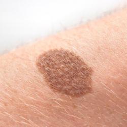 Example of moleRemoval
